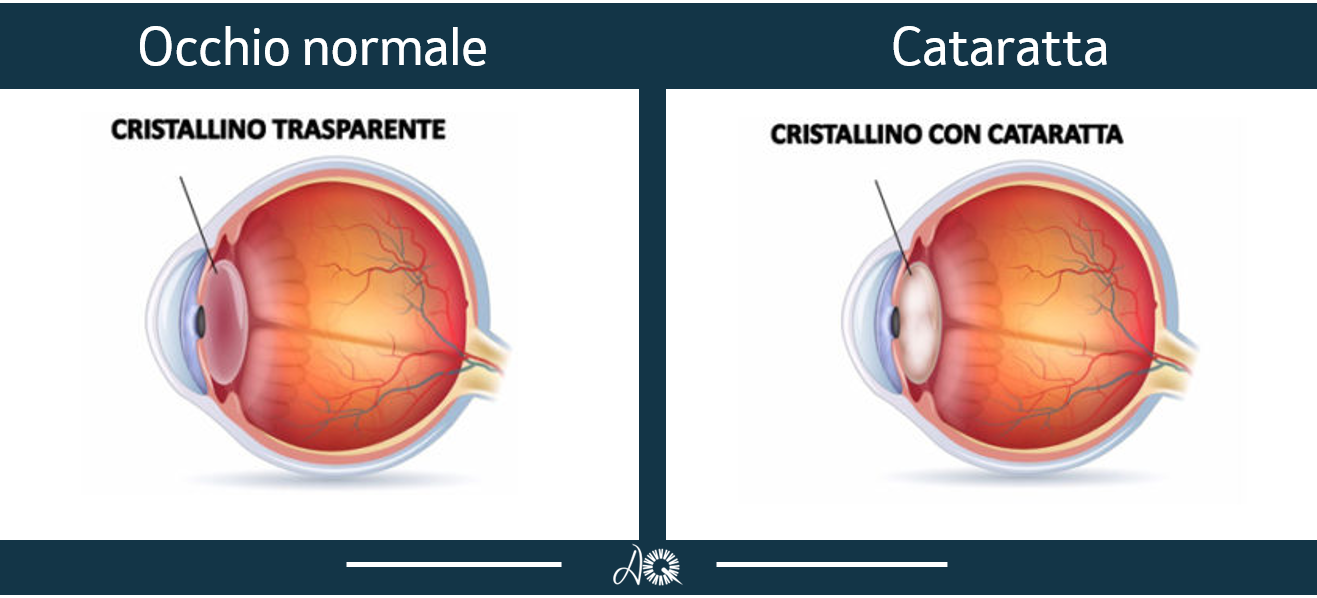 Cataratta